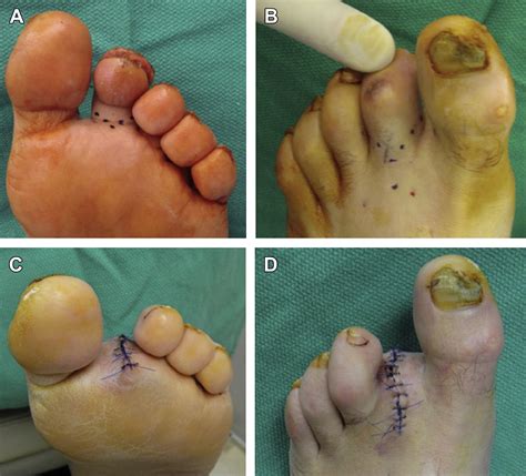 2015 Icd 10 Code For Post Op Amputation Foot