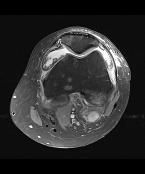 Tenosynovial Giant Cell Tumor Image