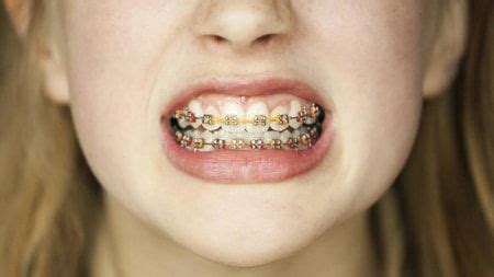 Plan does not cover every aspect of dental care. Dental Insurance That Covers Braces #Braces #dental # ...