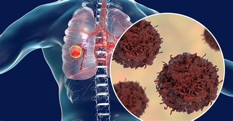 Lung Cancer Bloody Mucus And Other Common Signs Of Cancer In Your