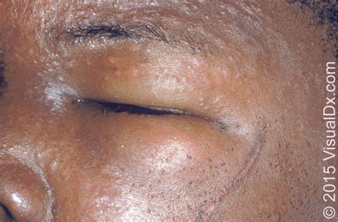 Differential Diagnosis Of The Swollen Red Eyelid Aafp