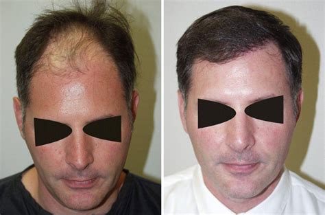 Hair Transplants For Men Photos Miami FL Patient39371