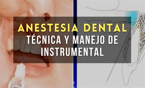 Anestesia Dental Técnica Y Manejo De Instrumental