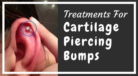 How To Get Rid Of Cartilage Piercing Bumps Professional Piercing Kits Piercing Bump Ear