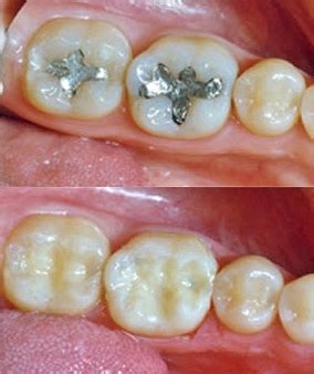 Composite fillings have many benefits that make them an excellent choice for our patients, like Alternatives To Amalgam Fillings
