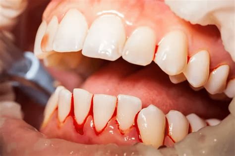 Is Gum Disease Serious Dentist In Owens Cross Roads Al