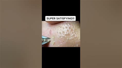 Pimple Popping 2021 Blackheads And Whiteheads 462 Youtube