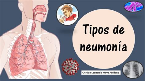 Neumonia Neumonia Atipica Tipos De Neumonia Kulturaupice