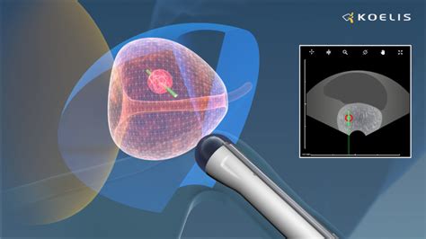 Transrectal Biopsy For Prostate Cancer Detection Koelis