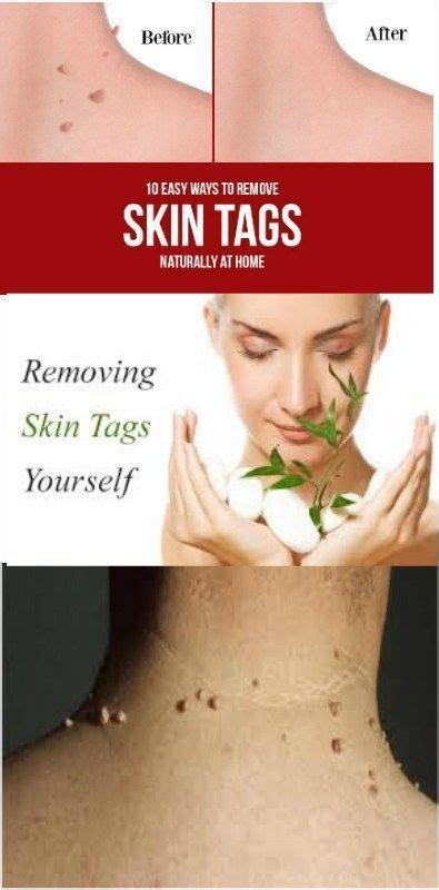 best remedies to get rid of skin tags naturally skintags skintagsoneyelids skin tag removal