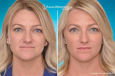 An underbite is when the lower jaw protrudes further out than the upper arch of teeth. Bite Correction without Surgery or Braces