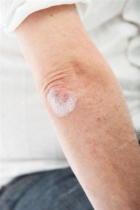 Psoriasis Skin Or Deciding On The Elbow — Stock Photo © Farina6000