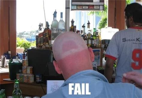21 Funny Sunburn Pictures Funny Sunburn Funniest Fails Ever Funny