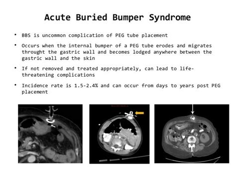 Buried Bumper Syndrome