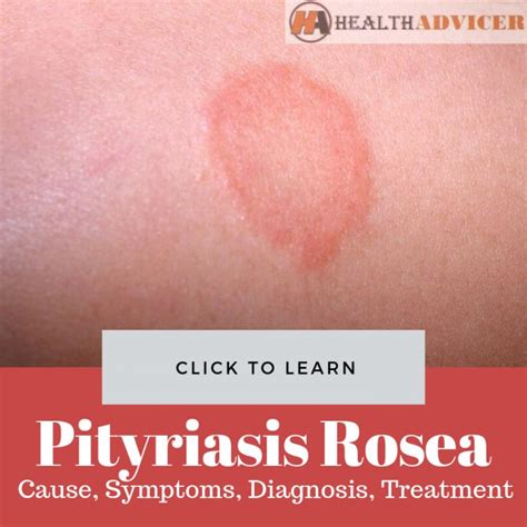 Know Facts About This Skin Disease Pityriasis Rosea Expert Health The