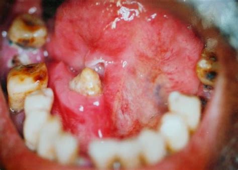 Salivary Gland Stone Photos