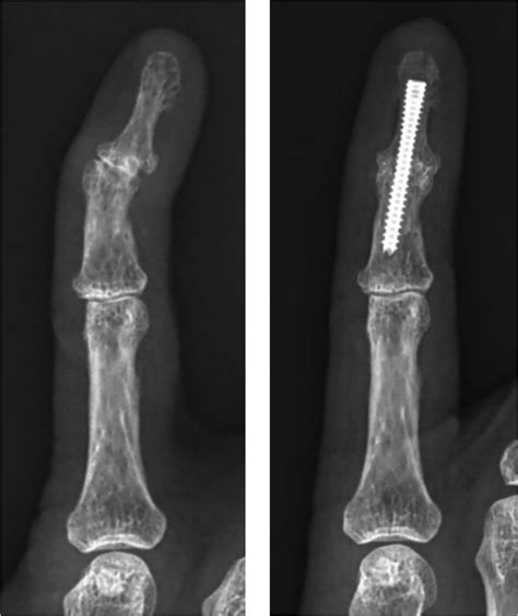 Finger Arthritis — Joseph J Schreiber Md