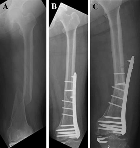 Distal Femur Fracture Classification Surgical Treatment Of Distal