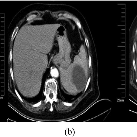 A Ct Scan Of The Abdomen Revealed A Low Density Lesion In The Spleen