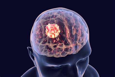 Inoperable Brain Tumors And Alternative Therapies Itc
