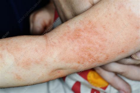 Eczema Stock Image C0263302 Science Photo Library
