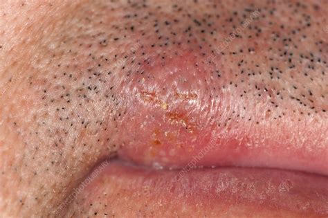 Cold Sore On The Lip Stock Image C0156045 Science Photo Library