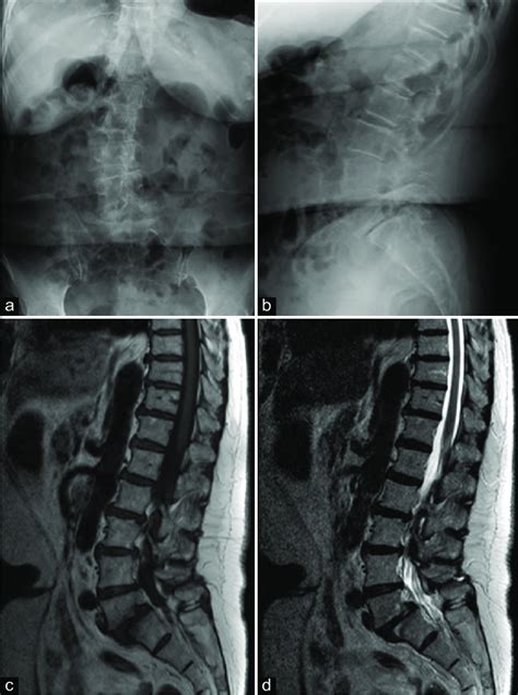 Anteroposterior A And Lateral B Radiographs Of The Lumbar Spine
