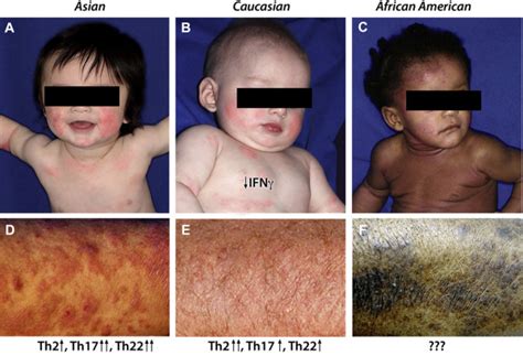 Atopic Dermatitis Age And Race Do Matter Journal Of Allergy And