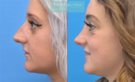 Rhinoplasty Nose Reshaping 003af Side The Private Clinic Of Harley