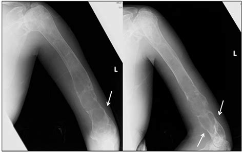Zoledronate Therapy For The Pathological Humeral Fracture In