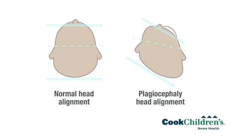 What Is Cranial Asymmetry