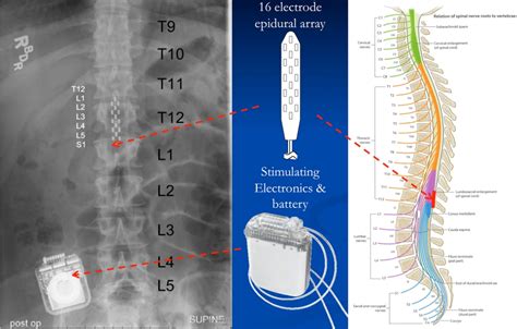 Know Your Spinal Cord Transcutaneous Spinal Stimulation Lunatic