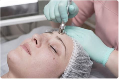 What Is Dermabrasion