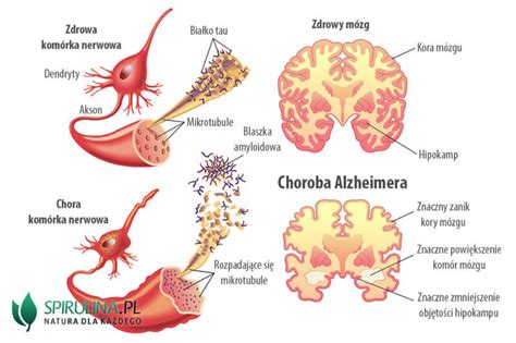 Choroba Alzheimera Algi Spirulina I Chlorella