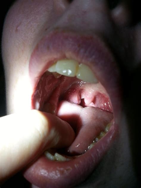 My Left Tonsil Is Swollen And I Believe Its Full Of Stones If Anyone