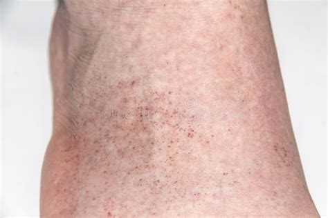 A Red Rash On The Foot Of A Male Against Background Closeup A Part Of