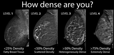 Breast Density Patient Experience