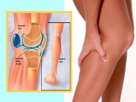 Ask An Orthopedist Baker’s Cyst Azalea Orthopedics