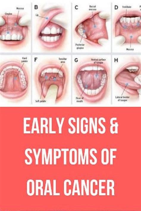 Early Signs And Symptoms Of Oral Cancer Oral Cancer Gum Disease Cure