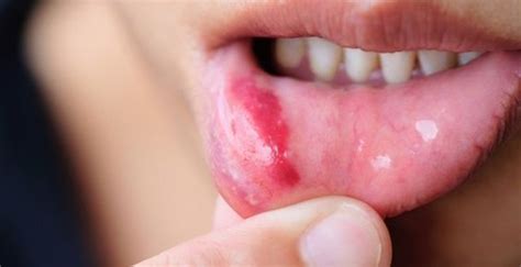Simple Skin Care Tips And Advice For You Canker Sore Pimples Mouth