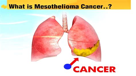 What Is Mesothelioma Cancer Mesothelioma Claims Mesothelioma Lawyer