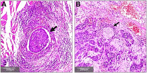 Lymphovascular And Perineural Invasion After Neoadjuvant Therapy In