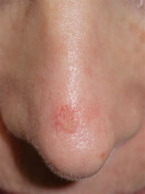 Basal Cell Carcinoma Nose Pictures Braun Free Glider