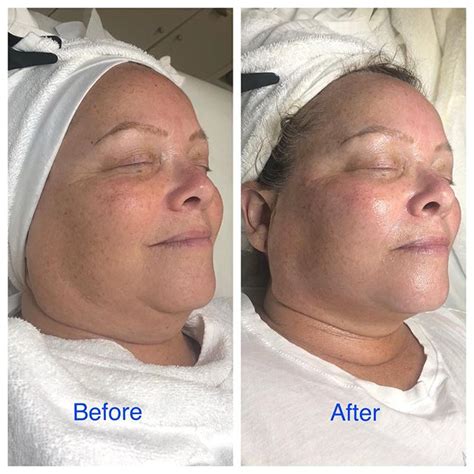 Nano Facial Before And After Face Fitness Skin Care