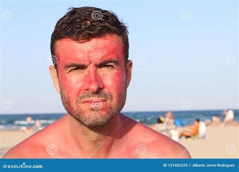 Man With Serious Expression After Getting Sunburned Stock Image Image