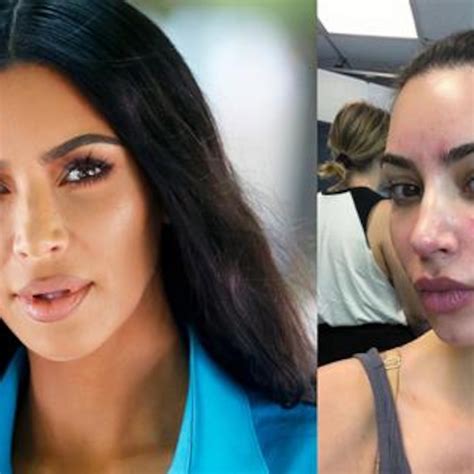 Kim Kardashian Opens Up About Painful Struggle With Psoriasis