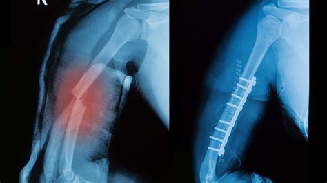 Advantages Of Treating Fractures With Absorbable Implants