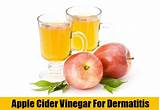 Photos of Seborrheic Dermatitis Home Remedies Vinegar