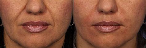Radiesse To Smile Lines Nasolabial Folds With Dr Grant Stevens Md