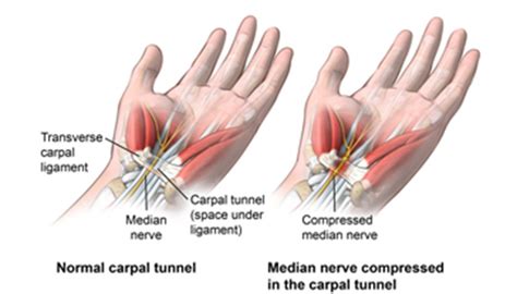 Carpal tunnel vs wrist tendonitis: Carpal Tunnel Syndrome | Johns Hopkins Medicine